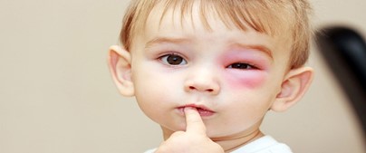 Phòng, chống bệnh do Adenovirus