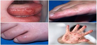 Bệnh tay chân miệng: không chủ quan!