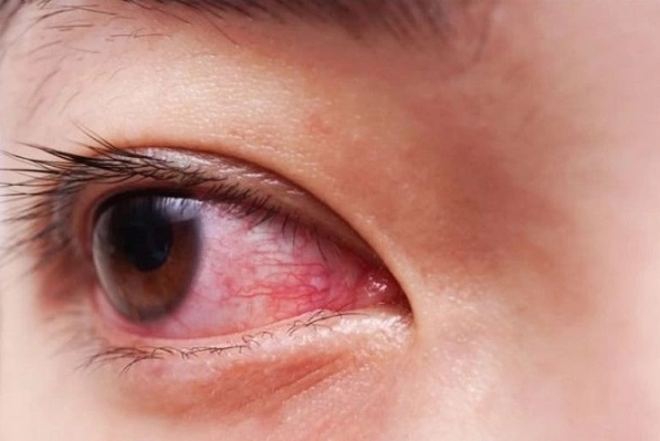 Rượu, bia ảnh hưởng đến mắt thế nào?